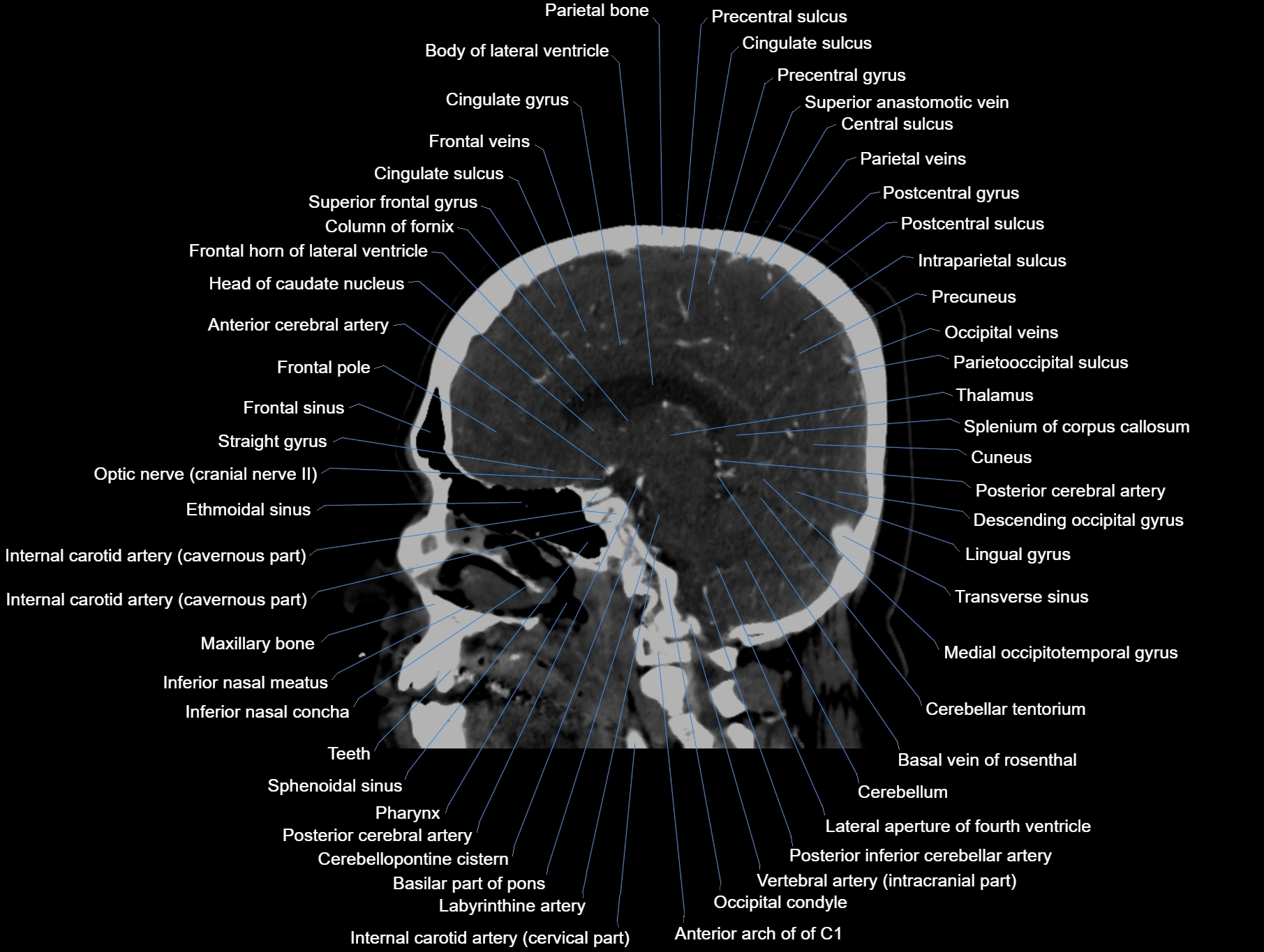 CT scan brain sagittal cross sectional anatomy image-img-00001-00035.webp